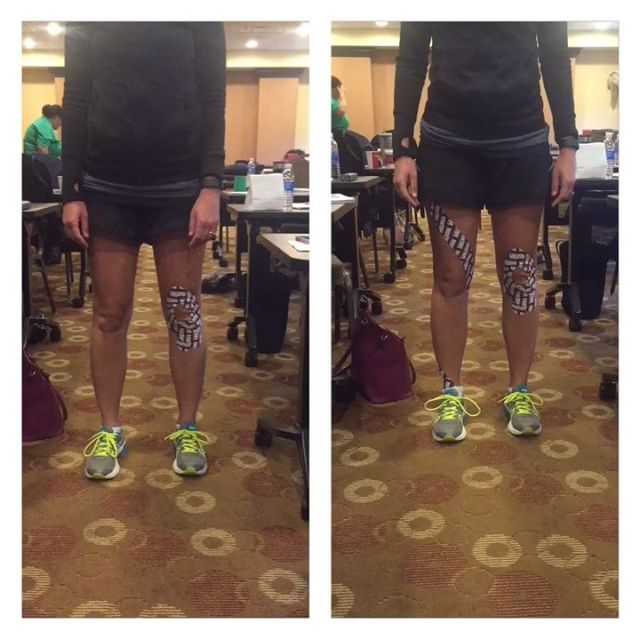 RockTape Spiral (Helical) Taping of the Lower Extremity for Knee Valgus with Squatting