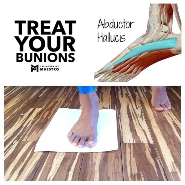 Abductor Hallucis Training to Treat Your Bunions